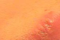 What Herpes Looks Like - Herpes & Coldsores Support Network