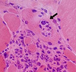 Granuloma Information - Herpes & Coldsores Support Network