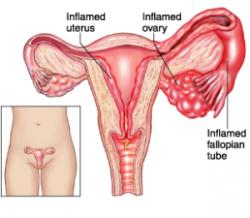 Pelvic Inflammatory Disease Information - Herpes & Coldsores Support Network