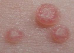 Molluscum Pictures - Herpes & Coldsores Support Network