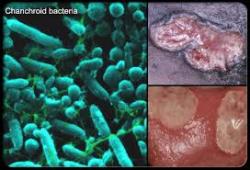 Chancroid Pictures - Herpes & Coldsores Support Network