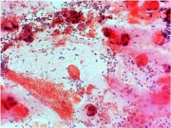 Bacterial Vaginosis Information - Herpes & Coldsores Support Network