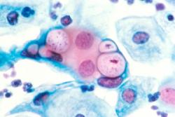 Lymphogranuloma Information - Herpes & Coldsores Support Network