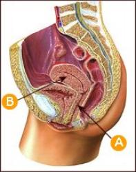 Pelvic Inflammatory Disease (PID) Pictures - Herpes & Coldsores Support Network