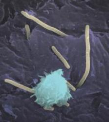 Urinary Tract Infection (UTI) Pictures - Herpes & Coldsores Support Network