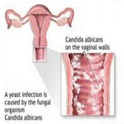 Yeast Infection Pictures - Herpes & Coldsores Support Network