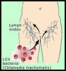Lymphogranuloma Pictures - Herpes & Coldsores Support Network