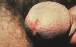 Nongonococcal Urethritis (NGU) - Herpes & Coldsores Support Network - Featured Image
