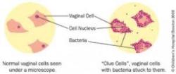 Bacterial Vaginosis Pictures - Herpes & Coldsores Support Network
