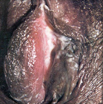 Chlamydia in vagina