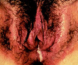 Chlamydia in female genitals
