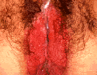 Female Chlamydia